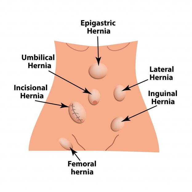 Stomach Hernia Treatment in Dubai